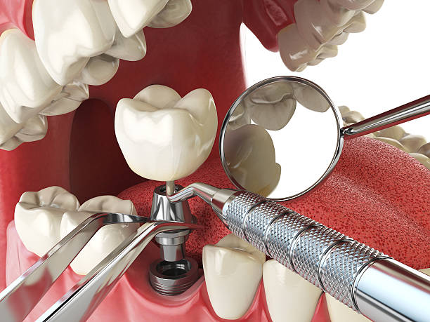 Best Knocked-Out Tooth (Avulsed Tooth) Treatment in Lula, GA